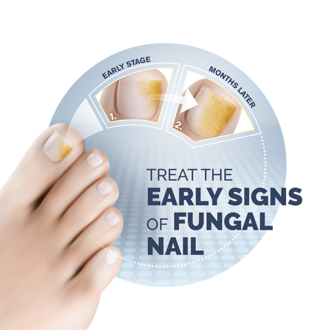 Get Ready For Summer: Get Rid Of Your Fungal Nail Infection – My FootDr